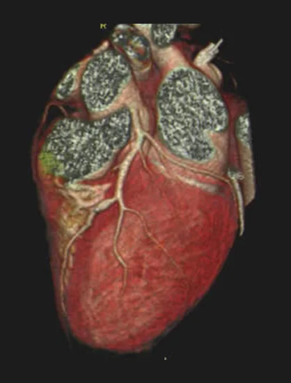 Computed Tomography Angiography