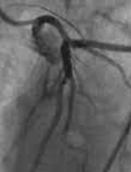 OCT in PCI Procedure Planning