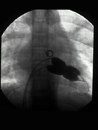 PBMV Procedure